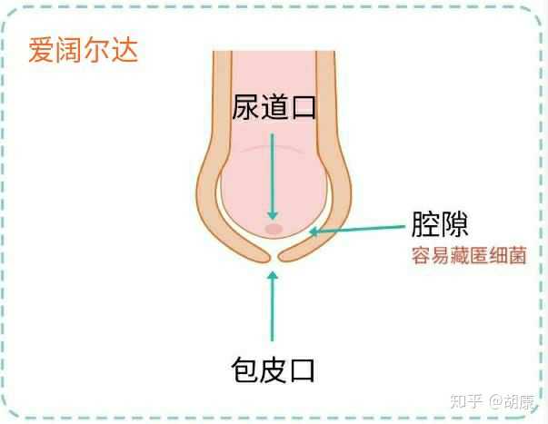 (如尿道下裂,眼睑烧伤) 附: 全球包茎扩张器发明一览: 澳大利亚的