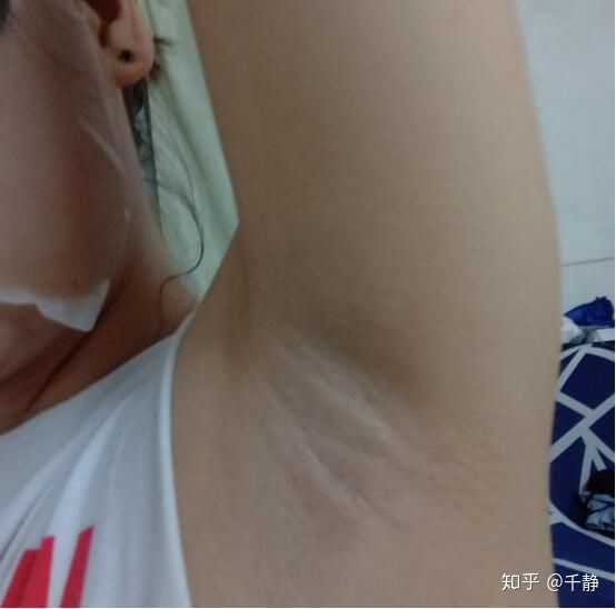 女性知友是如何处理自己的腋毛的?放任?定期刮?脱毛?