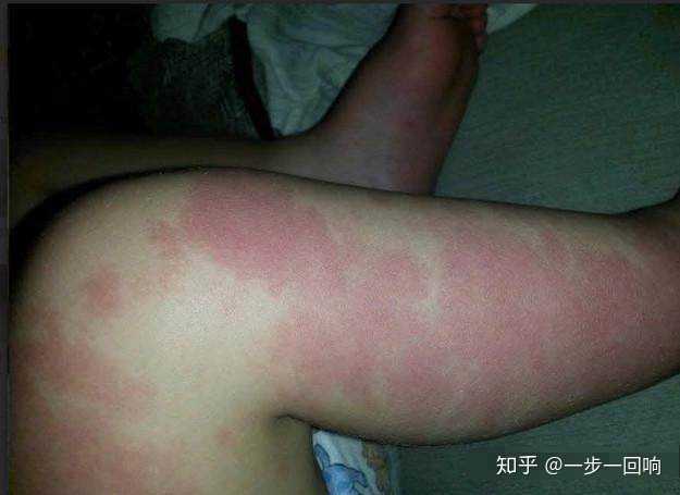 小女儿的胎记一直从大腿延伸到脚背.