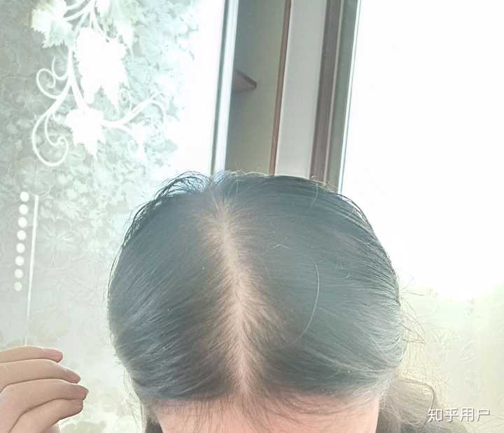 女生头顶头发少是什么体验 ?