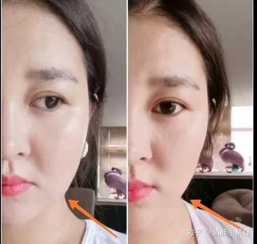 打肉毒素可能会有什么后遗症?