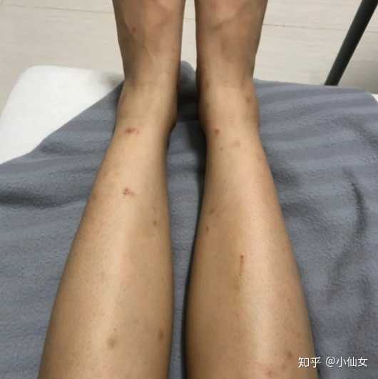 怎么去除被蚊子咬留下的黑疤?