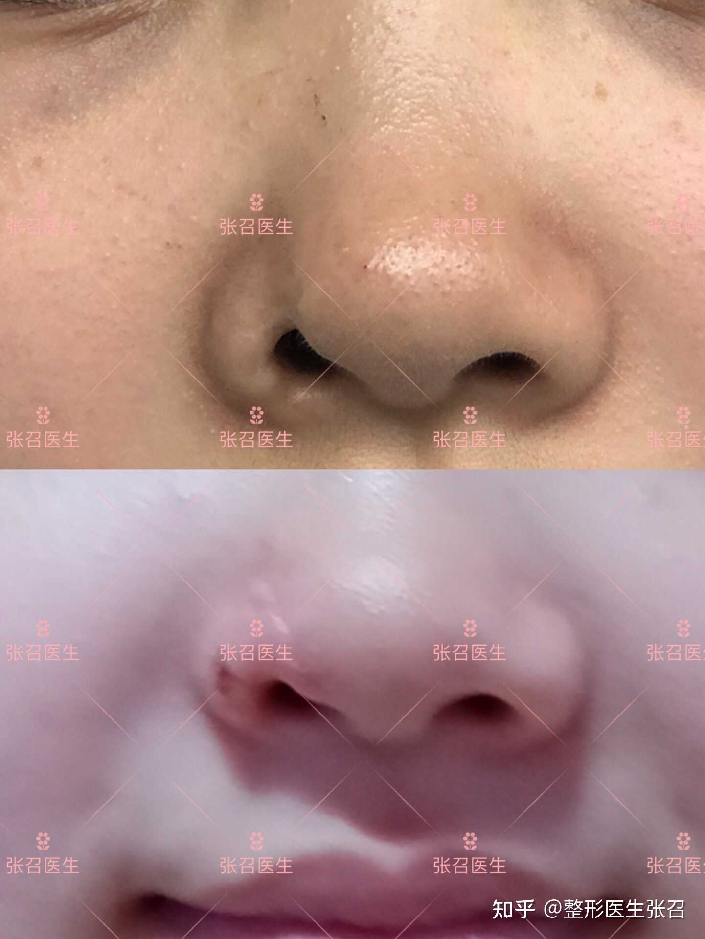 整形医生张召 的想法: 鼻翼缺损 上次那个鼻翼缺损小