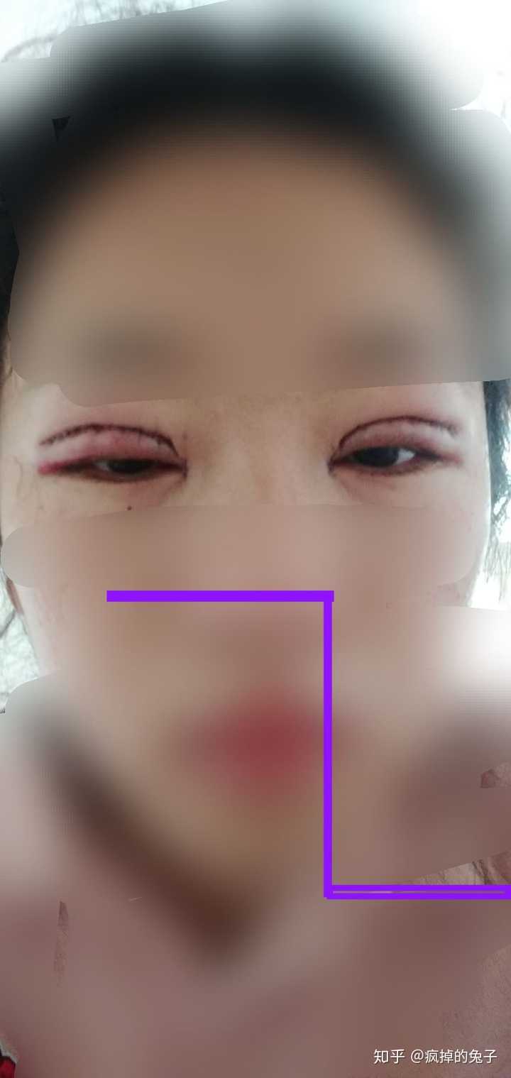许昌那家机构割双眼皮比较保险 ? 或哪家医院?