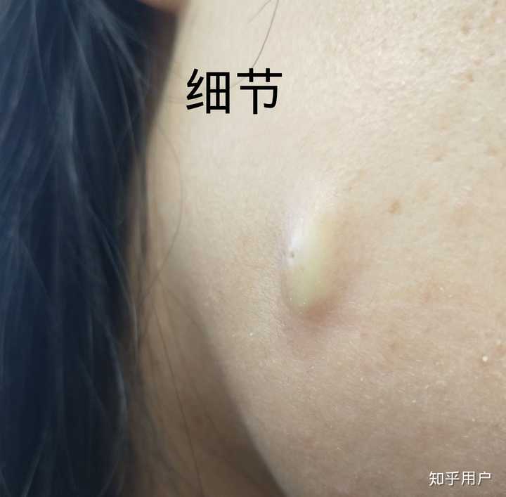 皮脂腺囊肿长在脸上了,医生说只能手术?