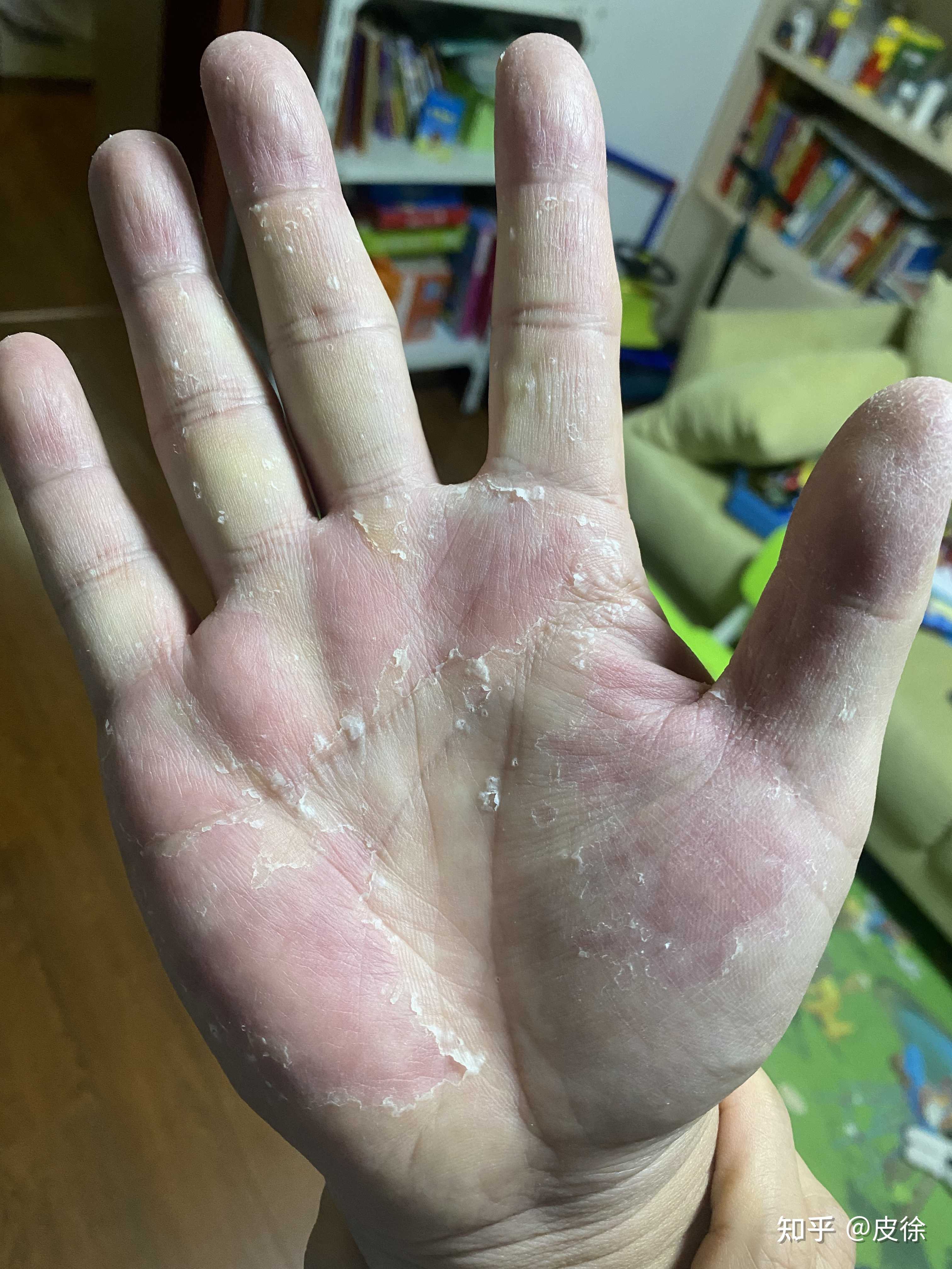 但是却没有太好的办法因为这种剥脱性角质松解症就没有特别好的办法