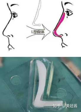一,硅胶隆鼻 其实最早一批的l型假体已经被淘汰了哈~ 现在都是i型和