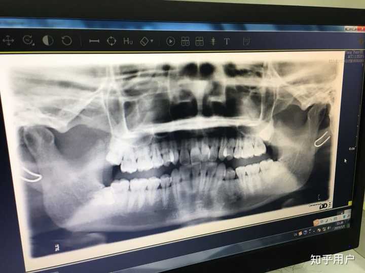 智齿横着长是一种怎样的体验?