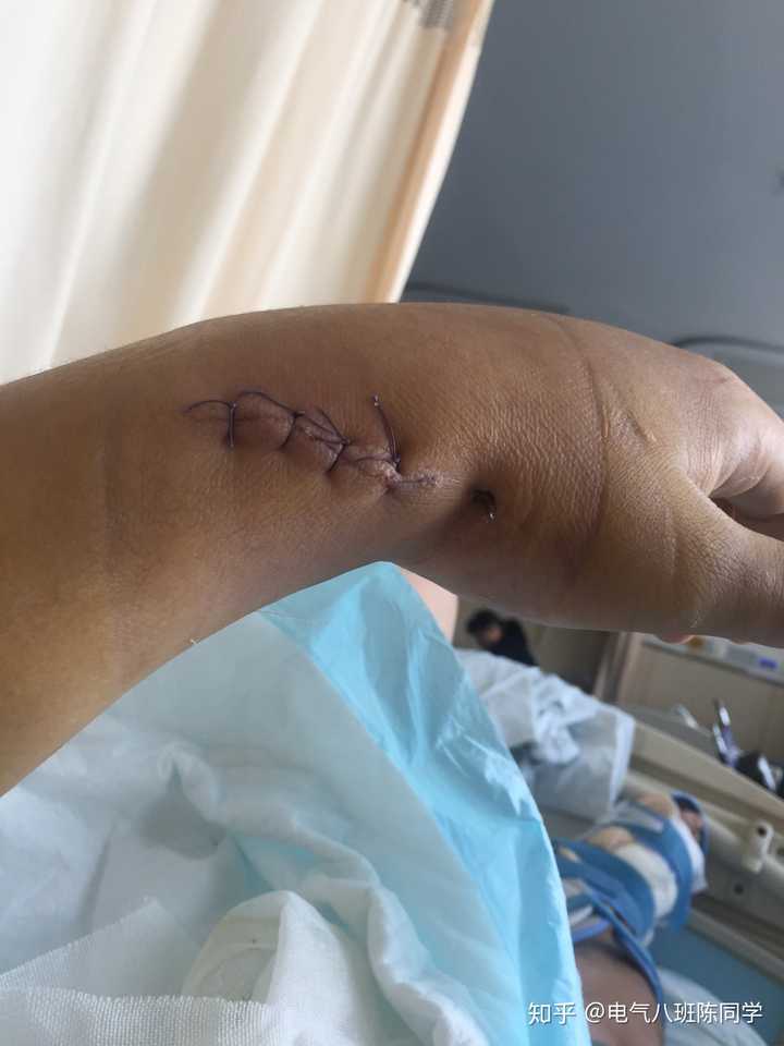 俩医生一个抓着手一个抓着手臂,硬生生地把错位的部位(手腕)给拉直