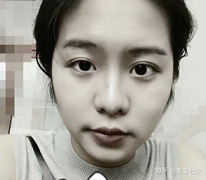 单眼皮突然变成双眼皮什么感受?