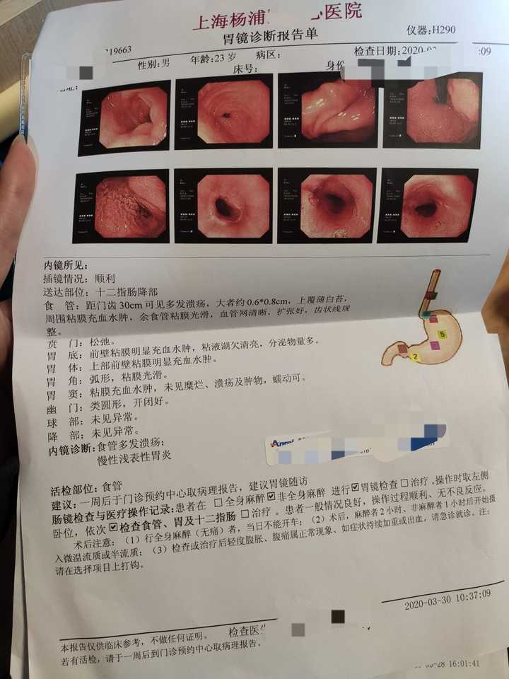 做胃镜是种怎样的体验?