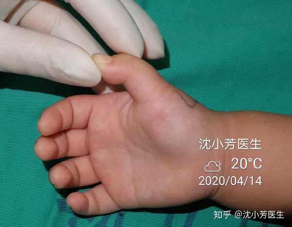沈小芳医生 的想法 儿童手指#狭窄性腱鞘炎 非常多见,如果 知乎