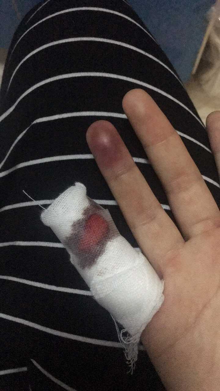 坏死,拿着根粗长的缝被子的针都会要在我受伤的指头上穿一个洞放血