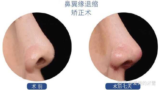 怎么才能缩小鼻翼?