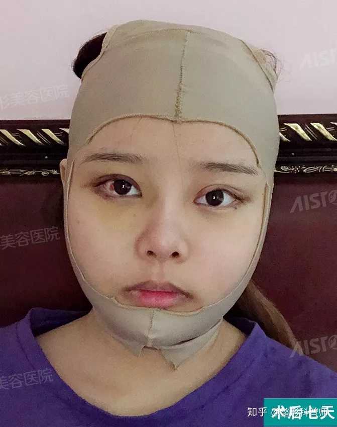整形削骨有后遗症吗?