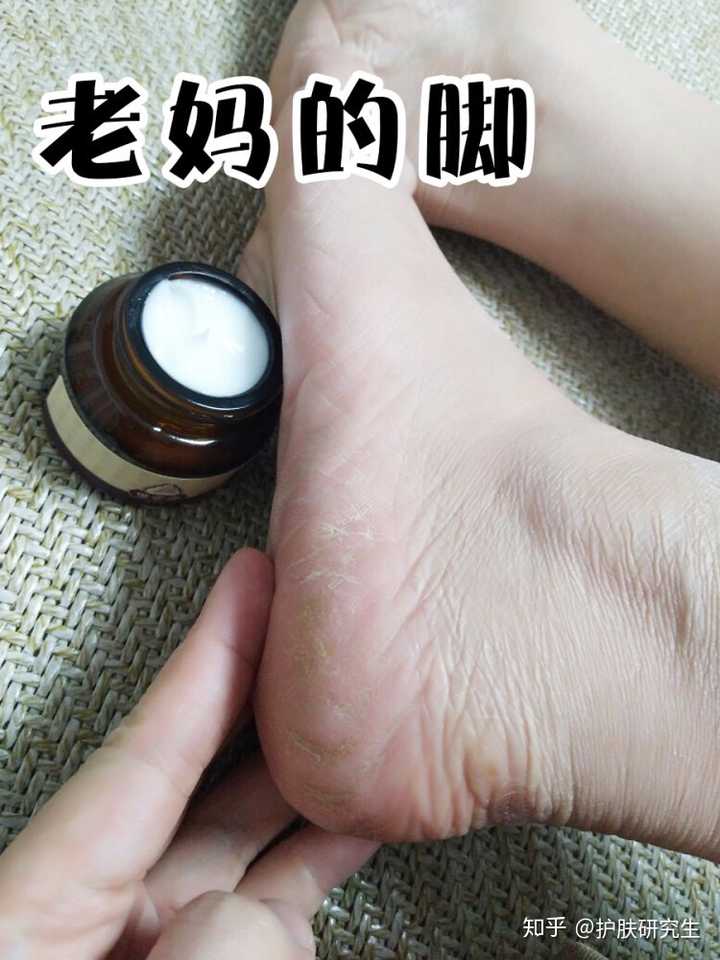 脚裂裂口子怎么回事?