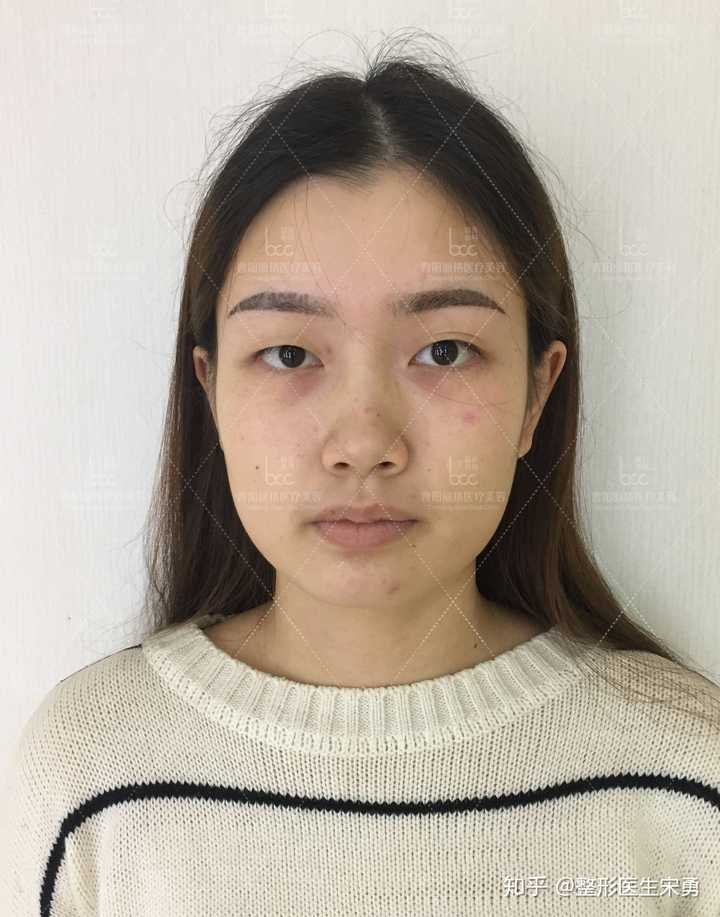 单眼皮变双眼皮真的能使人变好看吗?