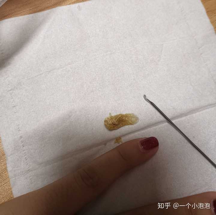 耳屎能大到什么程度