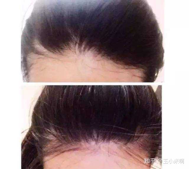 如何让发际线前移?