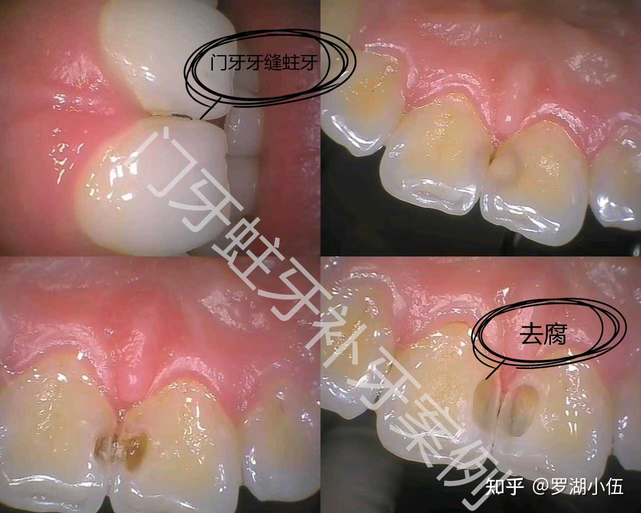 深圳连锁牙科牙医 的想法 门牙补牙案例分享 看出来这个门牙有补过