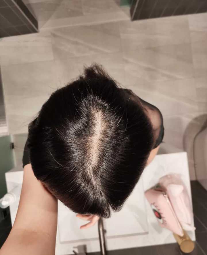 脂溢性脱发跟长期烫头有关系吗?