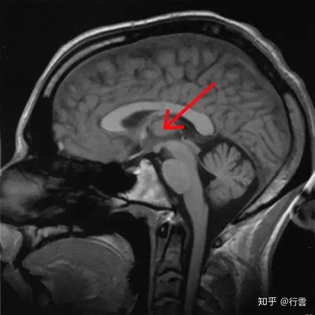 核磁共振成像人脑的矢状切面,红色箭头处为丘脑 来源:维基百科