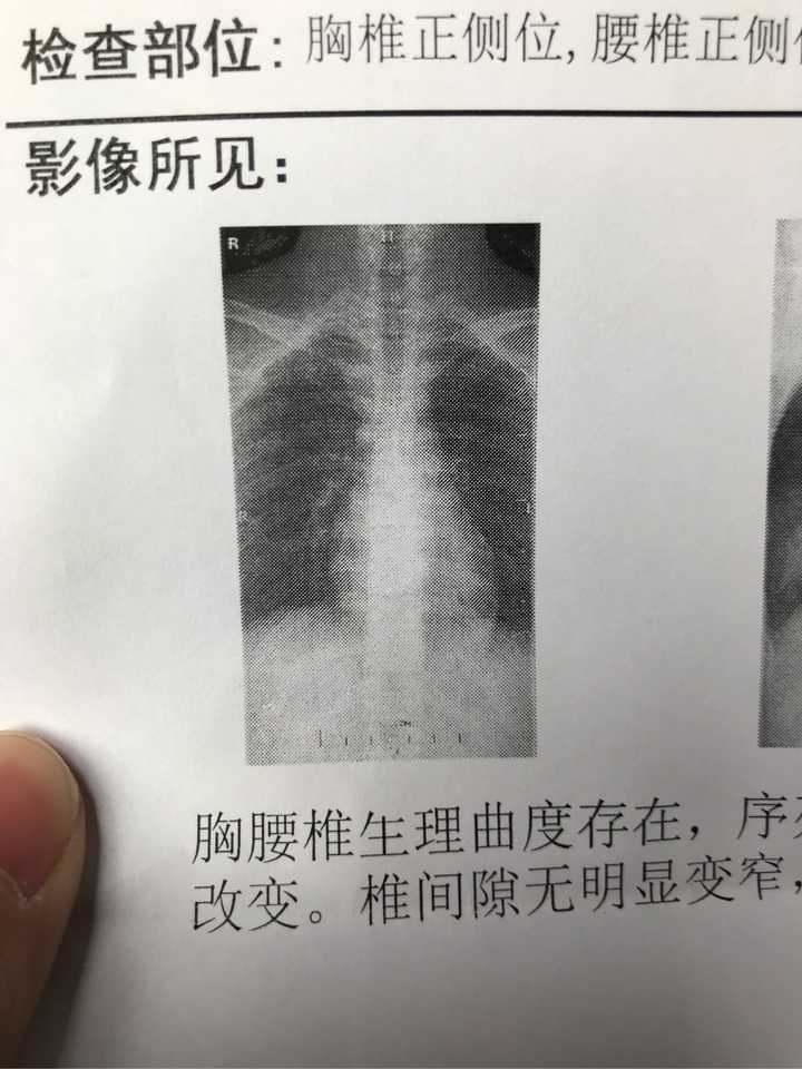 左肩胛骨下方有地方涨痛,躺着左背比右背稍高,去医院拍了脊椎,大家帮