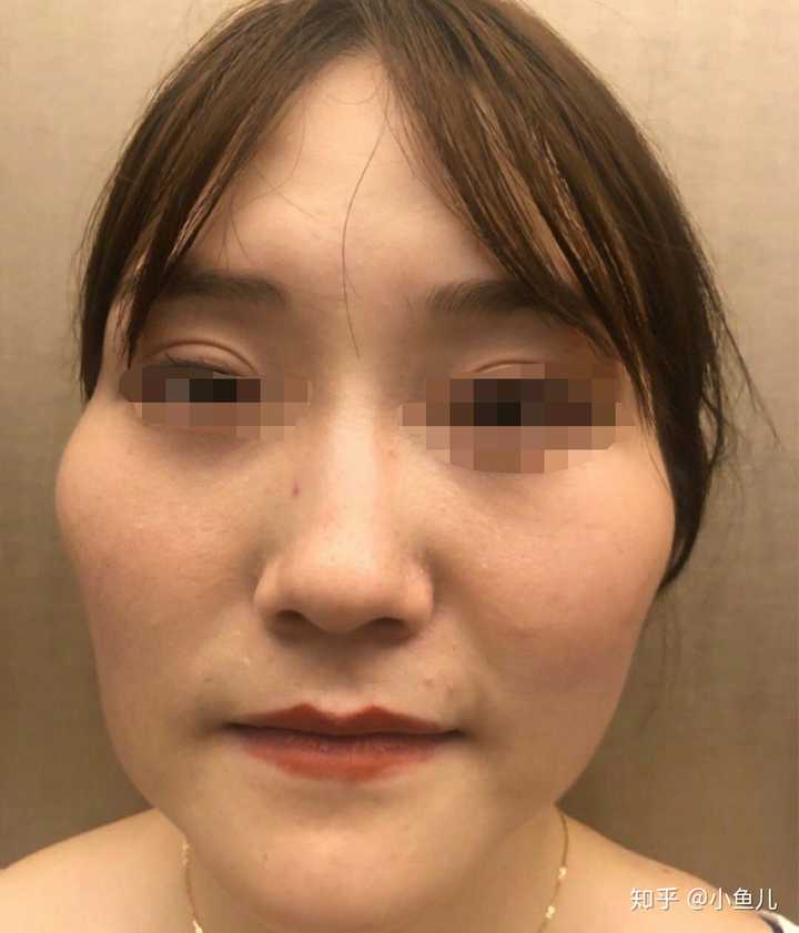 比如这个妹子,因为她天生颧骨过于突出,所以需要先做 颧骨内推,再配合