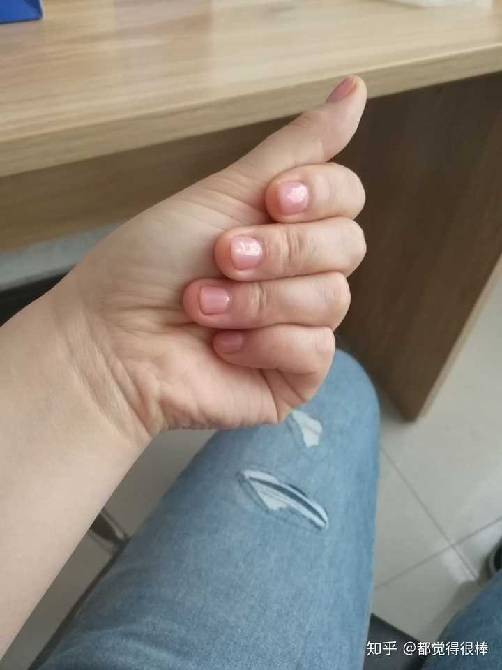 手指甲被咬的超级短怎么办?