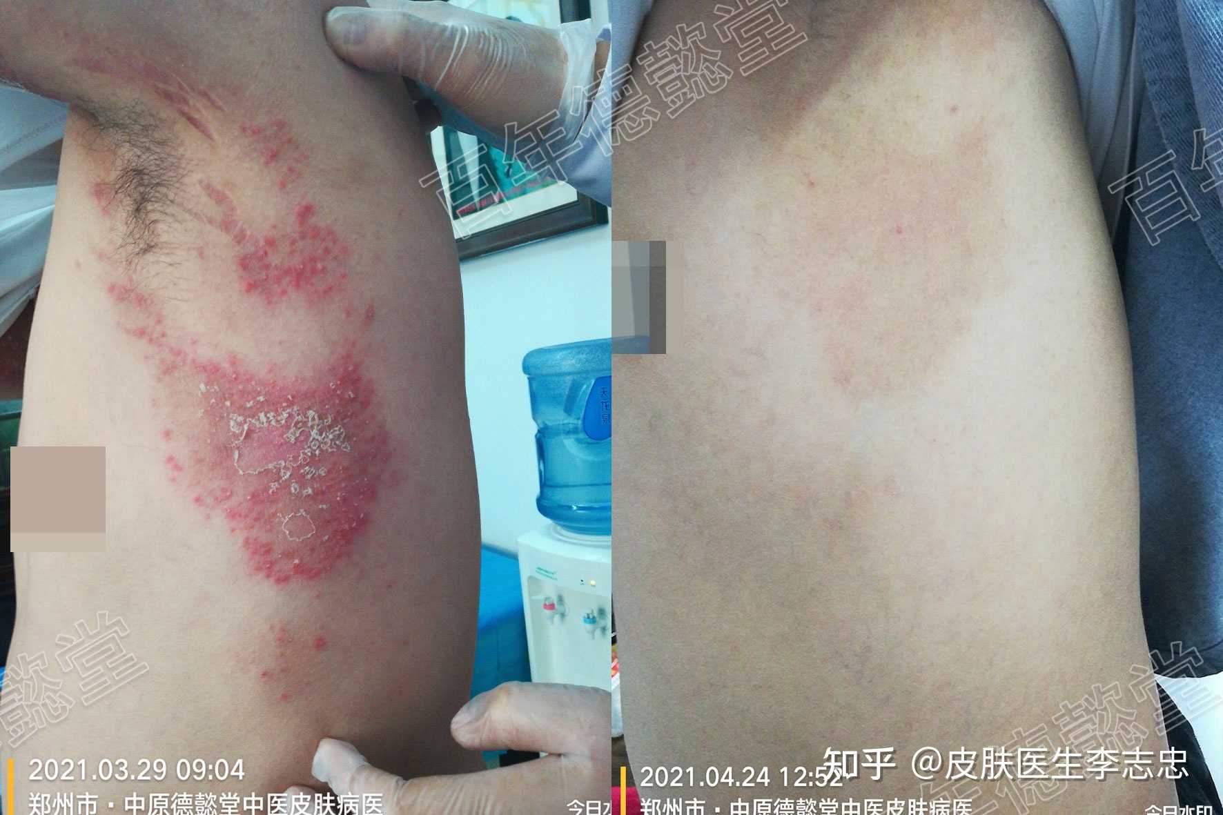 皮肤医生李志忠 的想法: 玫瑰糠疹,两侧腋下斑疹非常