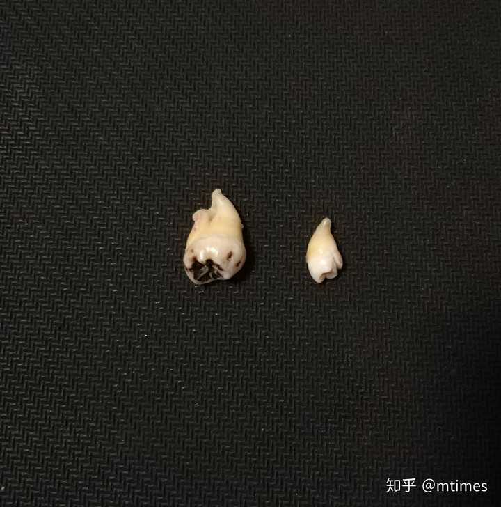 拔智齿有多痛?