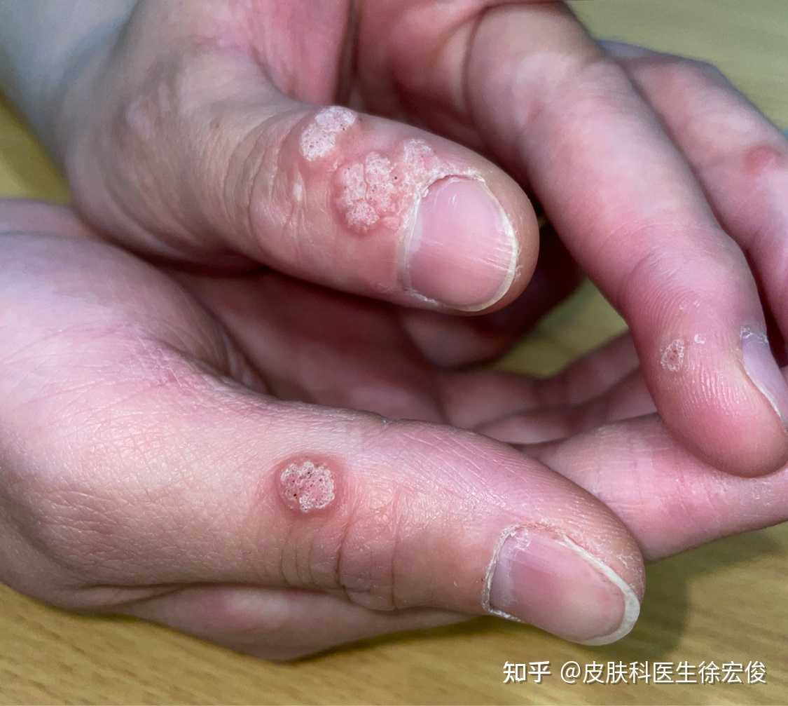 皮肤科医生徐宏俊 的想法: 这是手上的瘊子,叫寻常疣,hpv病毒感染