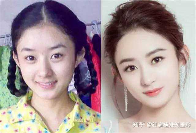 为什么很多明星的发际线那么高不去植发?