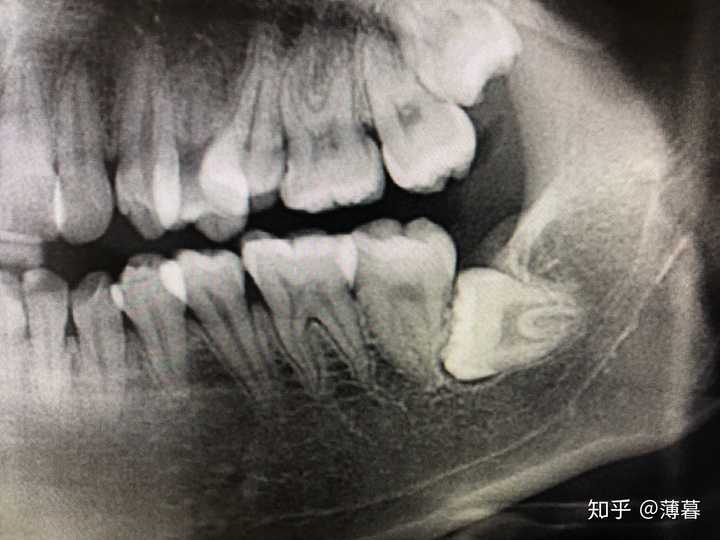 拔智齿有多痛?