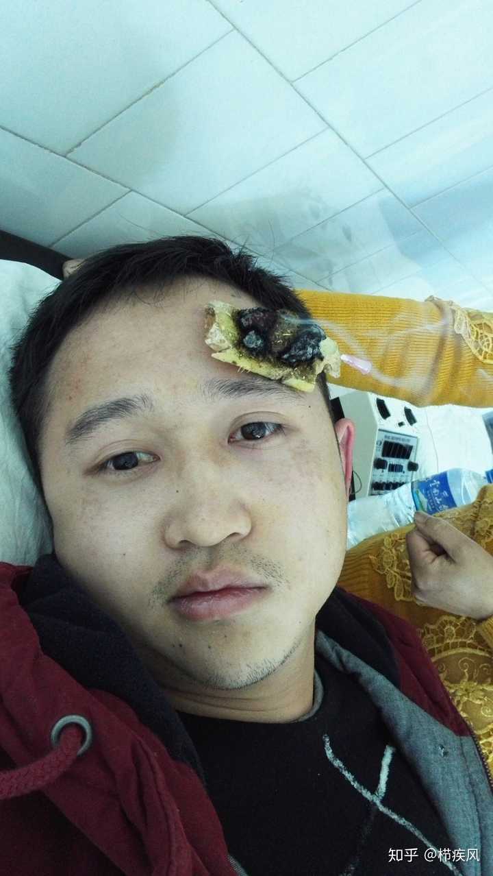 面瘫是一种什么样的体验?