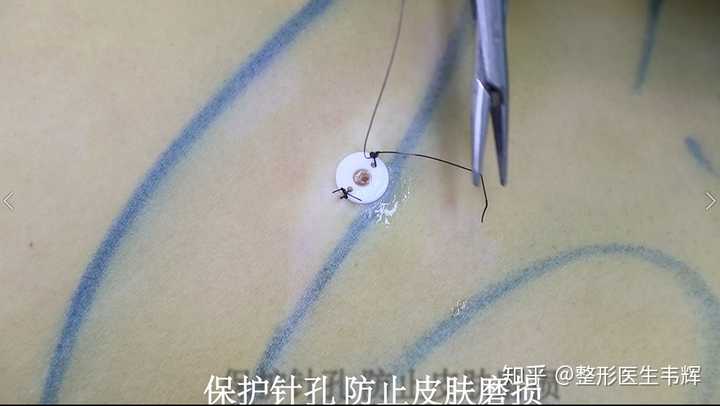 吸脂我们都会用专利的针眼保护器,防止在吸脂的过程中不断的摩擦创口