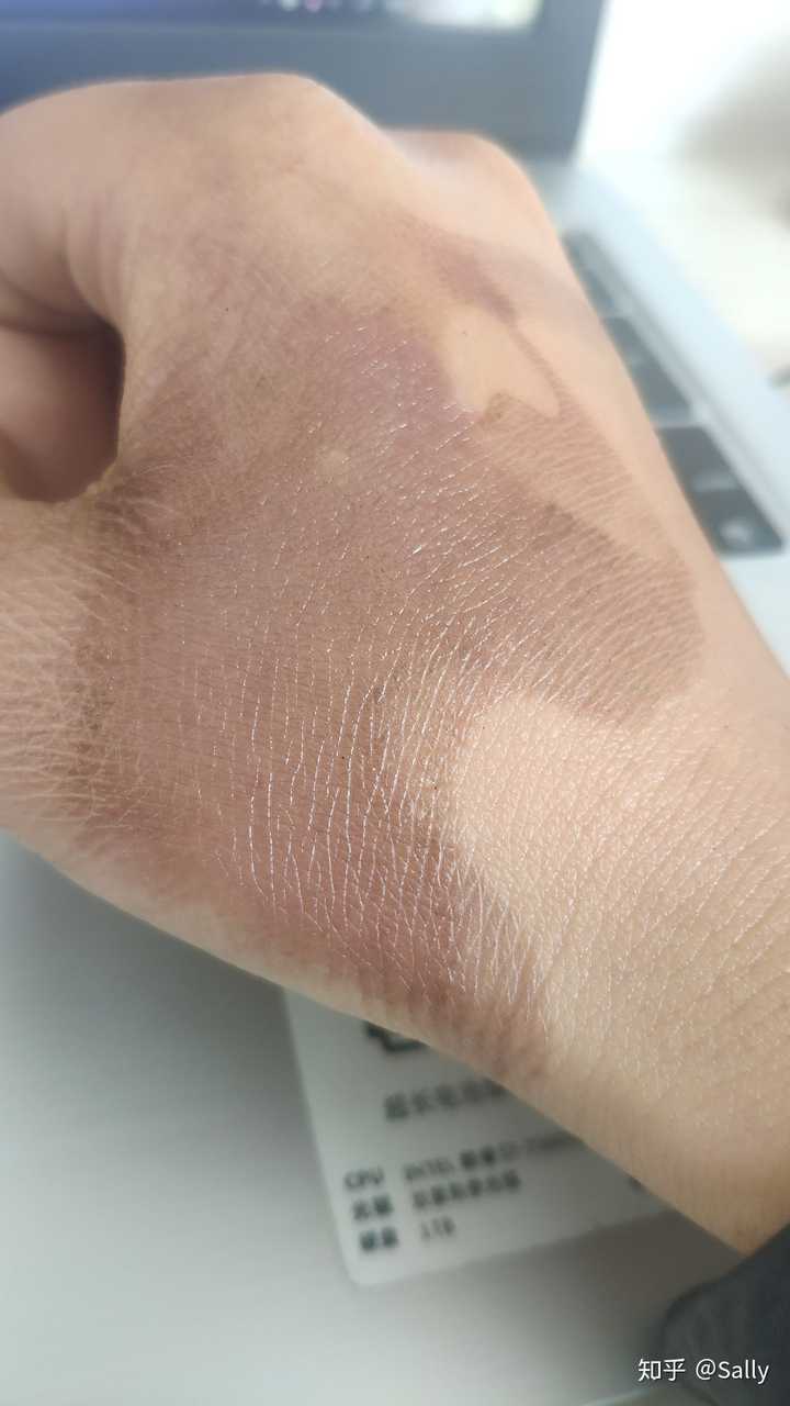 不要吃:辛辣,发物,酱油,醋等等,还有避免眼光直射,会导致色素沉着.