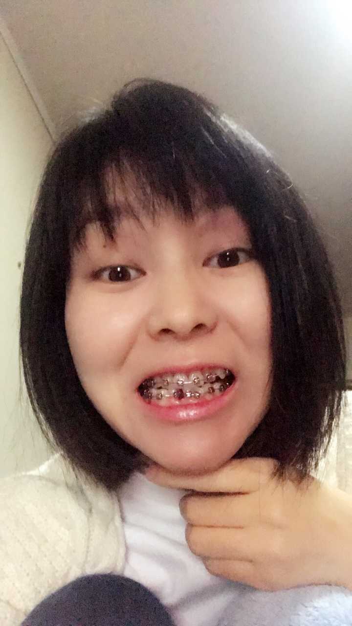 戴牙套正畸是什么体验