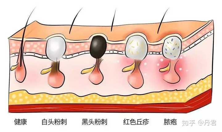 脸颊和鼻子上的黑头粉刺到底应不应该挤?