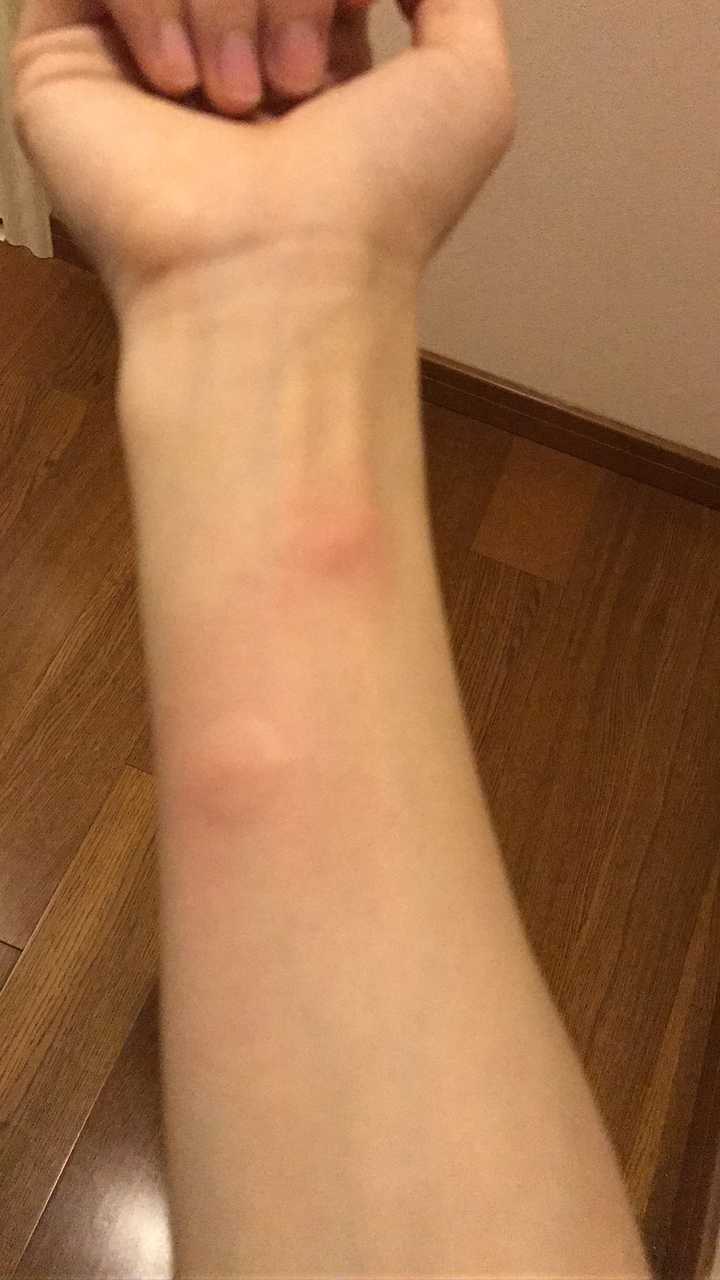 很讨厌 蚊子老是咬手掌边上,挠的时候不好使劲.
