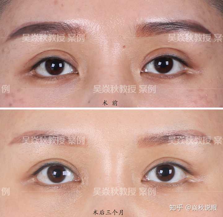 欧式重睑过宽 造成原因:追求欧式深邃大眼,重睑线高达15mm,不仅看起来