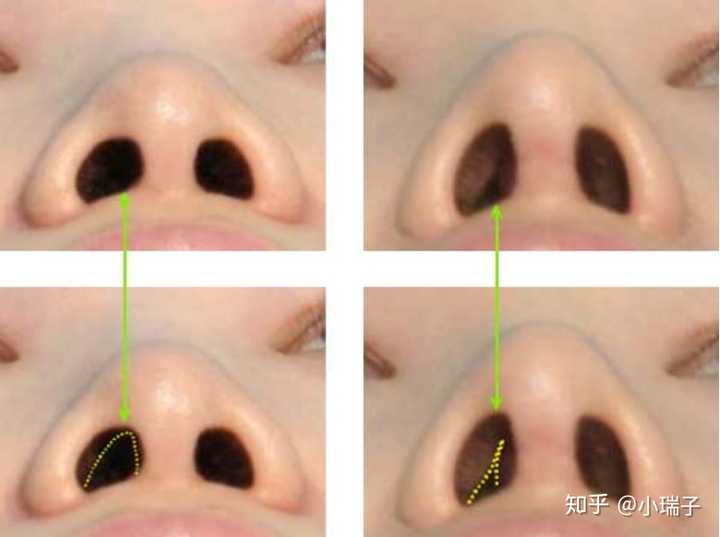 鼻中隔延长导致的鼻塞