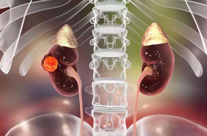 早期肾癌有什么临床表现吗?