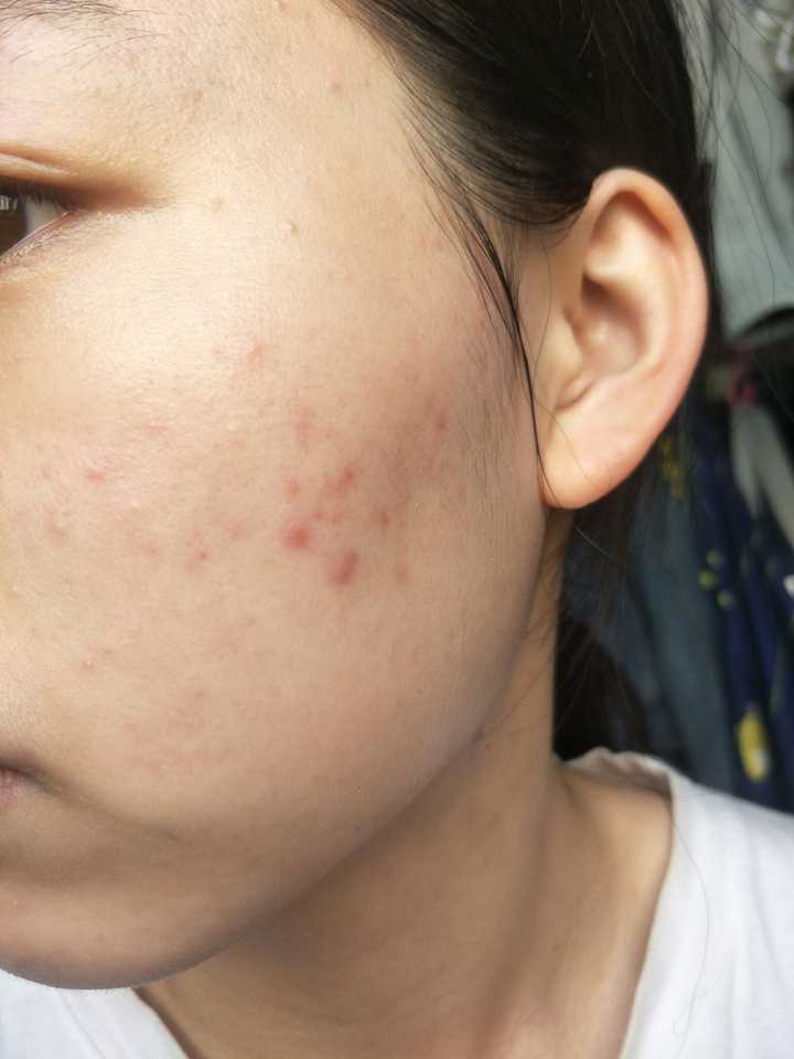 怎么看待五官漂亮但是皮肤差的女性