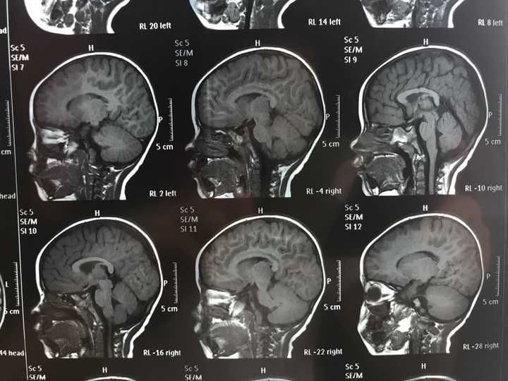 磁共振,双侧半卵圆中心及侧脑室后角旁白质异常信号,考虑扩大的血管