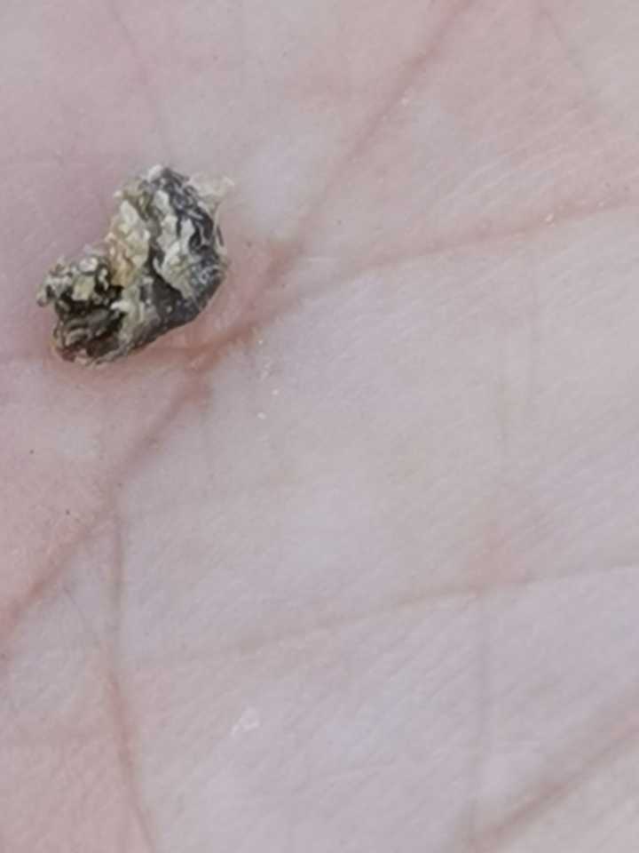 黑头大到直接挤出来是什么感受?