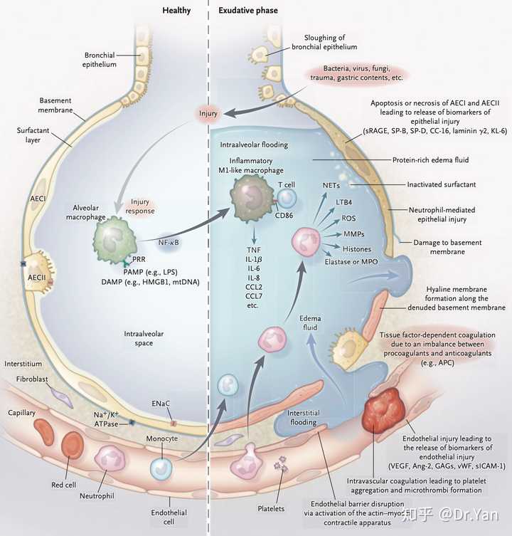 肺泡中的反应,图片来自nejm
