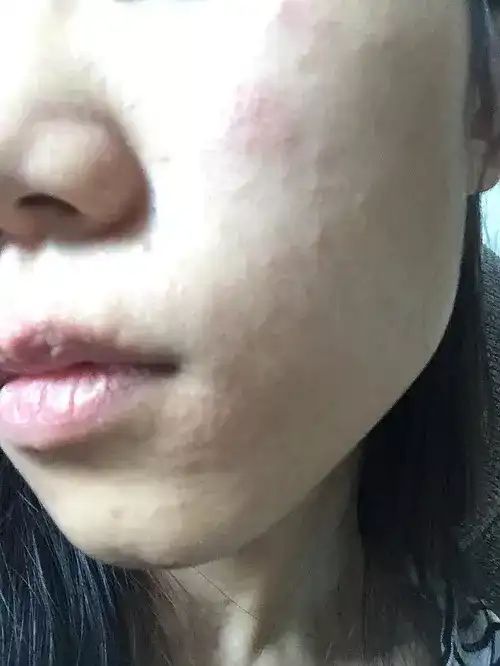 有脸部湿疹的治疗方法吗?