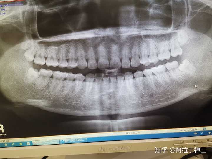 拔除智齿后患上干槽症,是种怎样的体验?