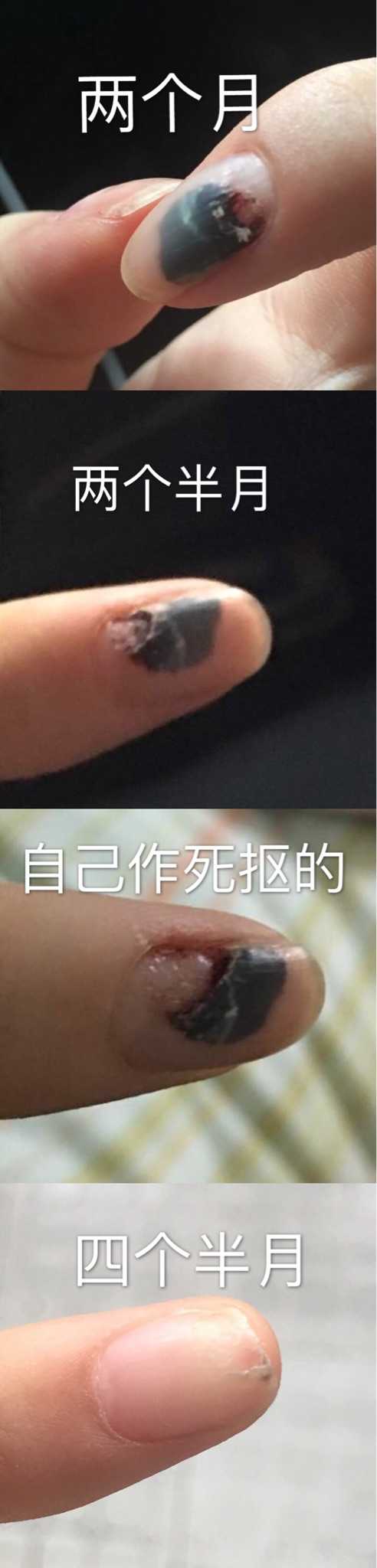 手指甲被夹到,过了一段时间,有黑色的淤血,怎么处理?